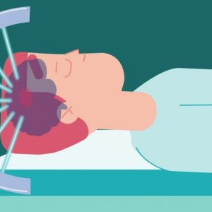 Изработка на explainer видео за acibadem - gamma knife 7