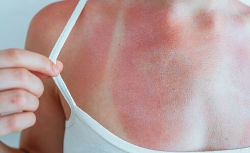 Swimsuit strap marks on young woman's sunburned skin
