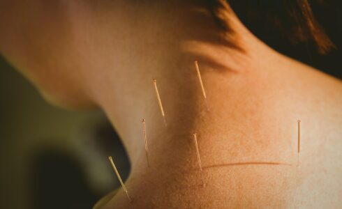 Young woman getting acupuncture treatment in therapy room