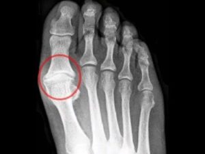 Middle toe pain 3 Big toe joint arthritis and ball of the foot pain.