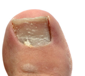 Chronic Pain In Feet 5 Keratin granulations white patches on big toenail