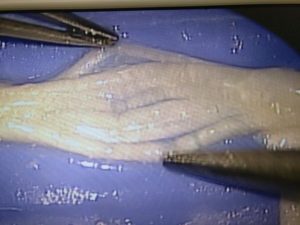 Foot Neuralgia 1 Morton Neuroma Morton Neuralgia Dissection anatomy treatment guide