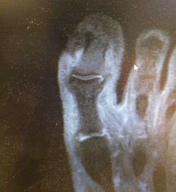 Staph Infection on Toe 4 big toe joint ulcer with bone infection from ingrown toenail