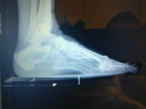Painful Heel Lump or Bump on the Back of the Foot 3 Achilles tendonitis insertional heel spur back of the heel spur