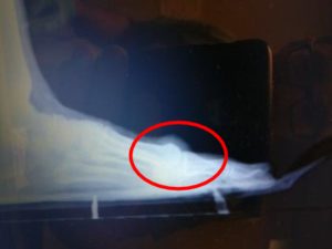 Foot Doctor Top Foot 6 top of the big toe joint bone spur top of the foot