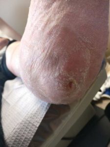 Staph Infection on Toe 1 early staph infection on heel and foot