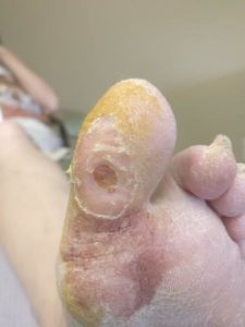 Staph Infection on Toe 2 Staph infection on big toe or foot