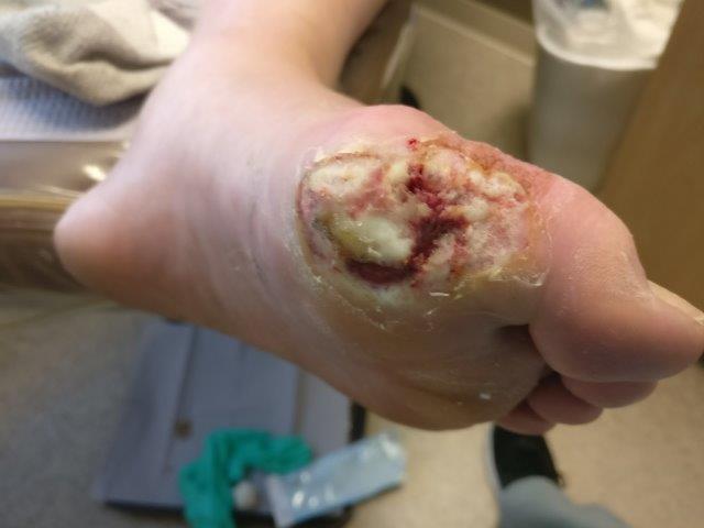 Staph Infection on Toe 5 Staph infection of the big toe & staph infection of the foot