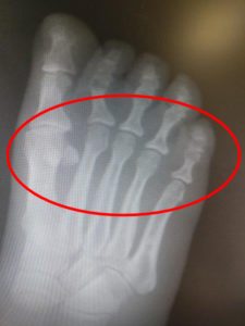 Middle toe pain 2 Metatarsalgia ball of the foot pain