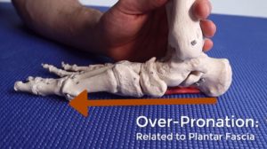Sharp Heel Pain In The Foot Diagnosis Guide 3 Plantar fasciitis due to overpronation