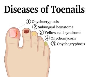Podiatrist Ingrown Toenail 2 Michigan Podiatrist House Calls & Home visits
