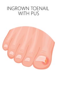 Podiatrist Ingrown Toenail 4 podiatrist ingrown toenail removal surgery