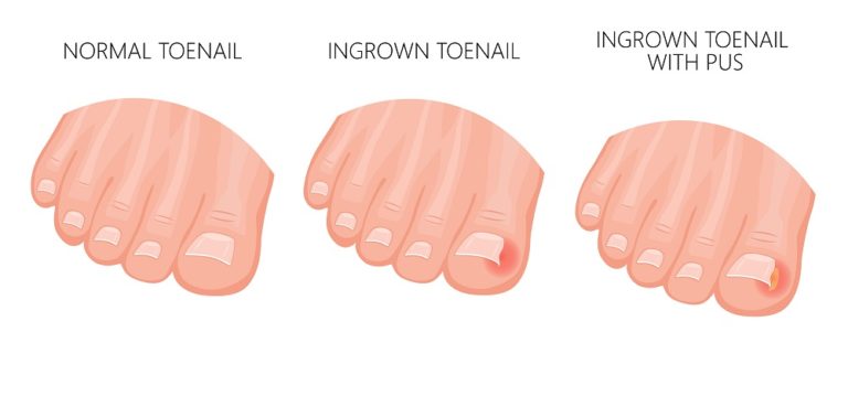 Podiatrist Ingrown Toenail 1 How to fix an ingrown toenail podiatrist treatment