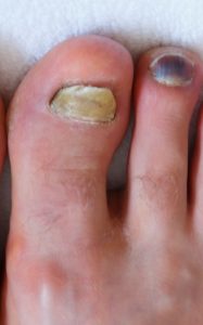 Podiatrist Ingrown Toenail 3 how do podiatrists remove ingrown toenails