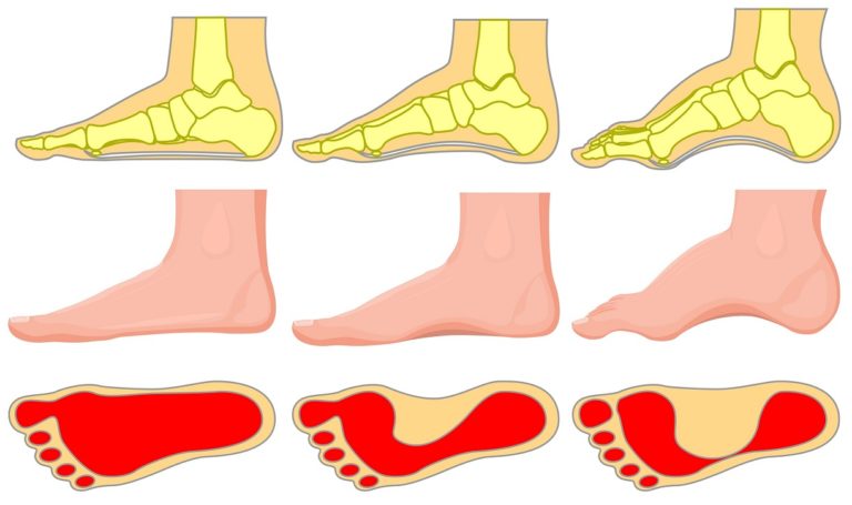 best shoes for morton's neuroma pain