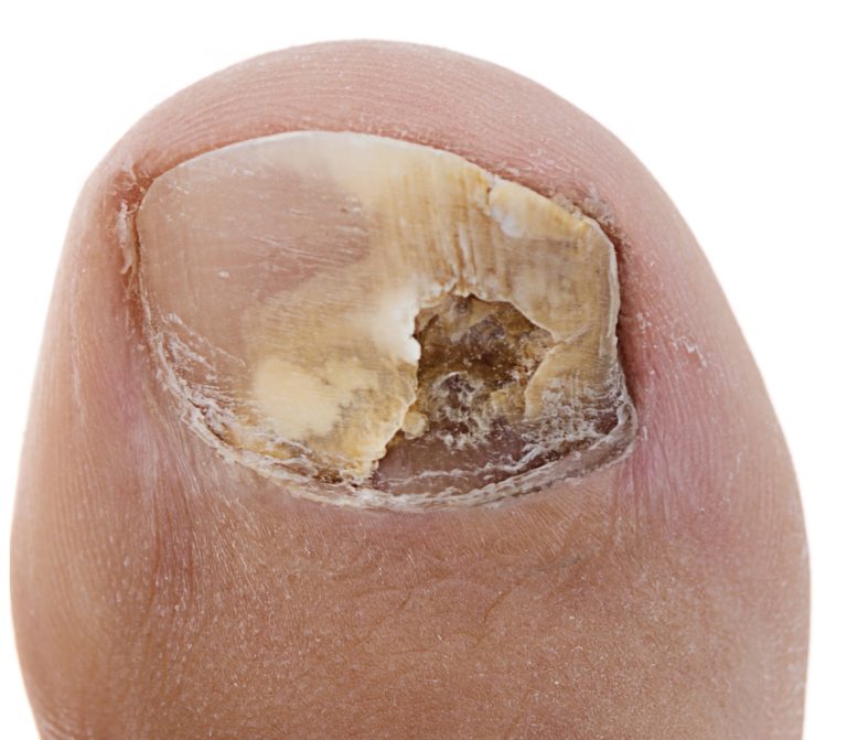 Impacted Toenail Treatment 2 Deep horizontal ridge in the toenail or dent in the toenail.