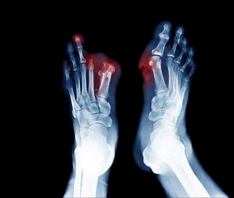 Can you walk without a big toe? 5 can you walk without a big toe