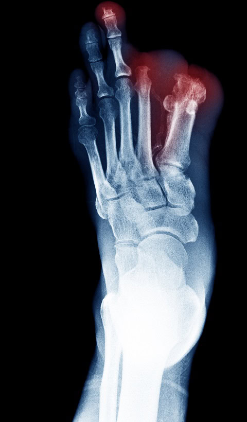 Can you walk without a big toe? 6 can you walk without a big toe