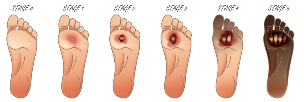 Staph Infection on Toe 3 can you walk properly without a big toe