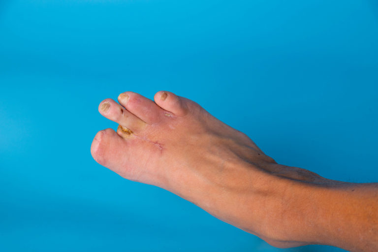 Can you walk without a big toe? 4 can you still walk without a big toe
