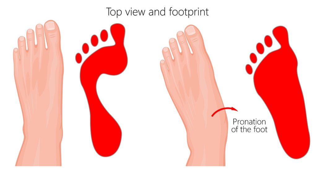 Overpronation Flat Feet Pain Treatment 7 flat feet pain relief