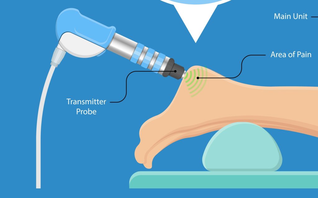 EPAT Treatment Plantar Fasciitis 1 EPAT Treatment