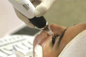 dermapen-gorica