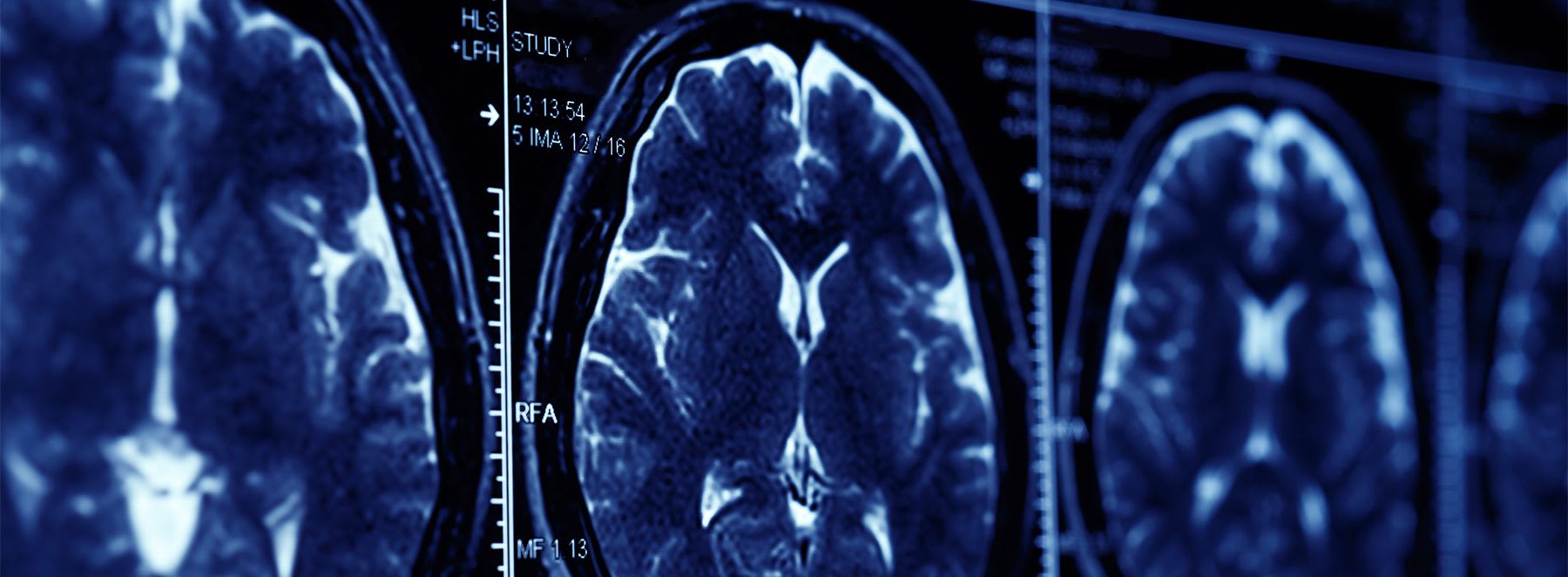 High sugar intake linked to poorer mental health in men