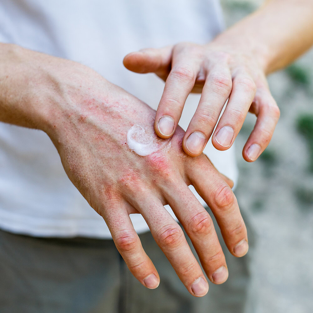 How nutritional therapy may help with eczema