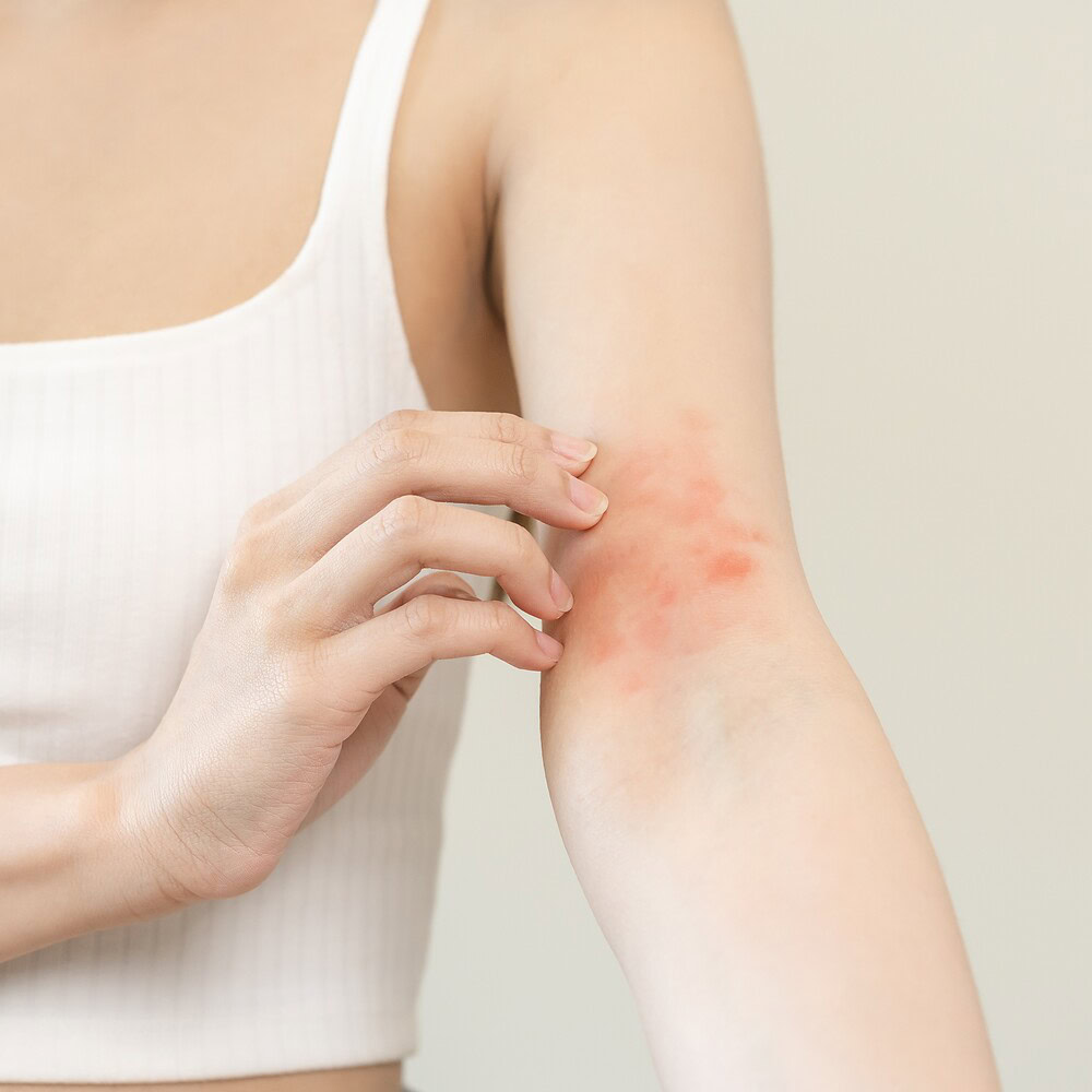 From chronic eczema to clear skin: How food became one woman’s remedy