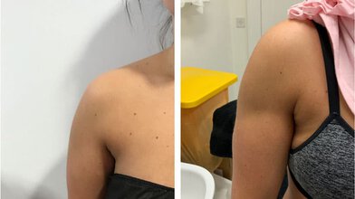 Shoulders – Vaser Lipo Clinic
