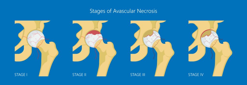 Stages of Avascular Necrosis