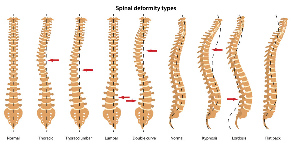 Scoliosis Spinal deformity types. Anterior view and lateral view of spinal. Anatomical vector illustration in flat style isolated over white background.