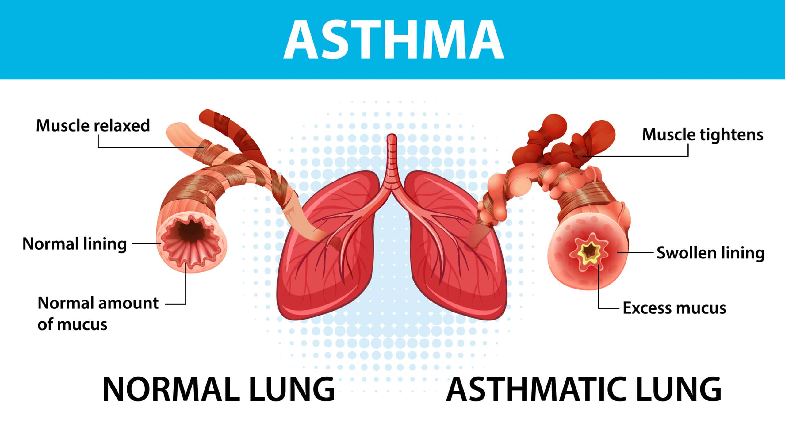 Asthma diagram with normal lung and asthmatic lung illustration