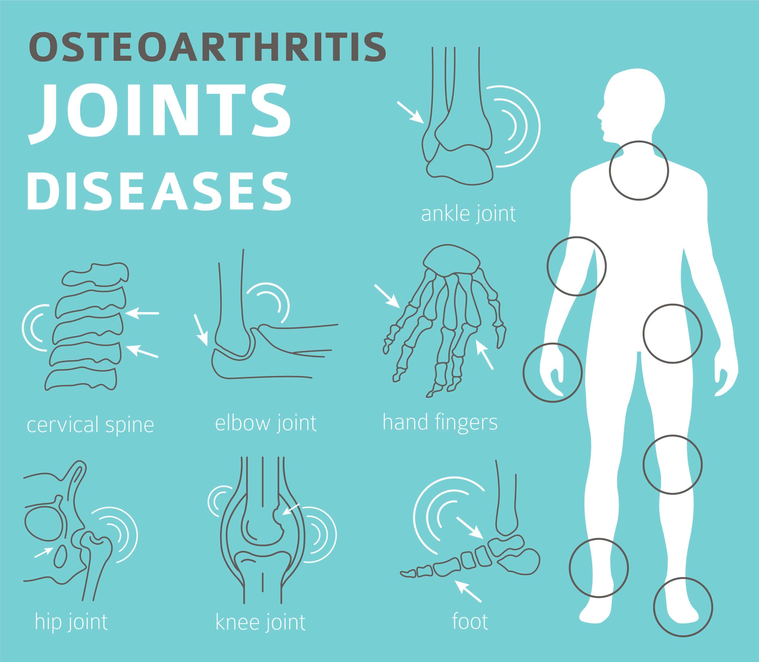 osteoarthritis Joints diseases. Arthritis, osteoarthritis symptoms, treatment icon set. Medical infographic design. Vector illustration