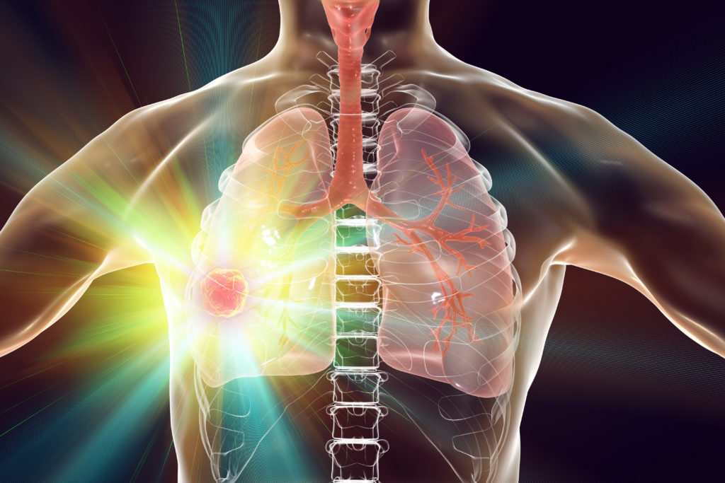 Lung cancer treatment and prevention concept, 3D illustration